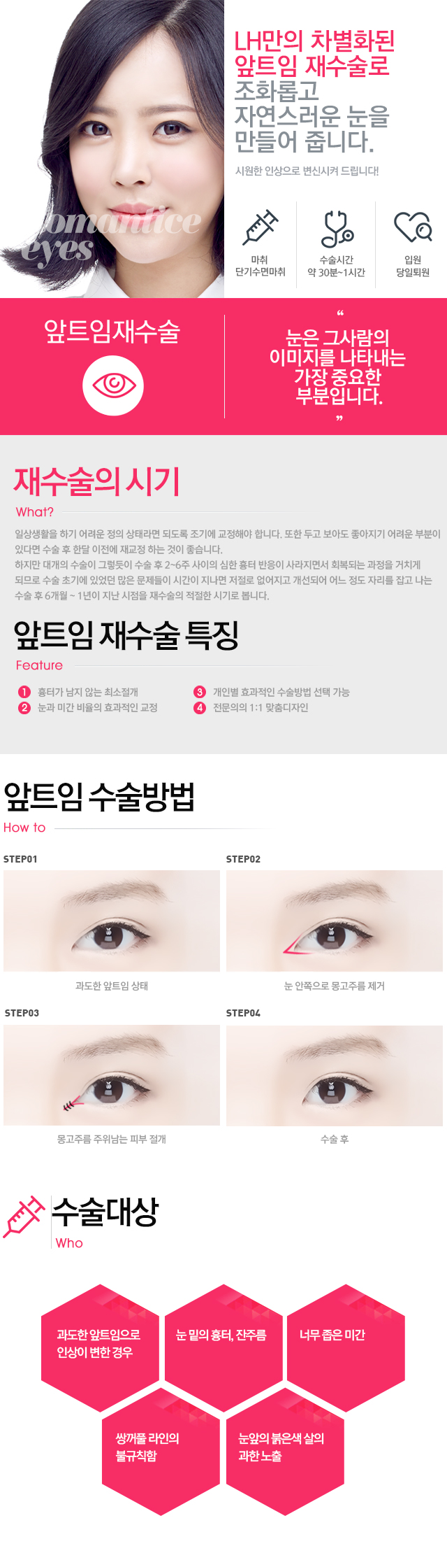 앞트임재수술