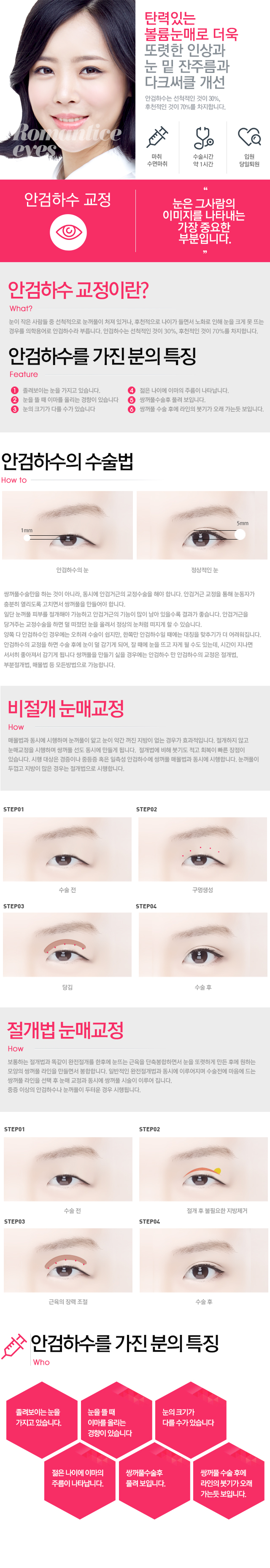 안검하수교정