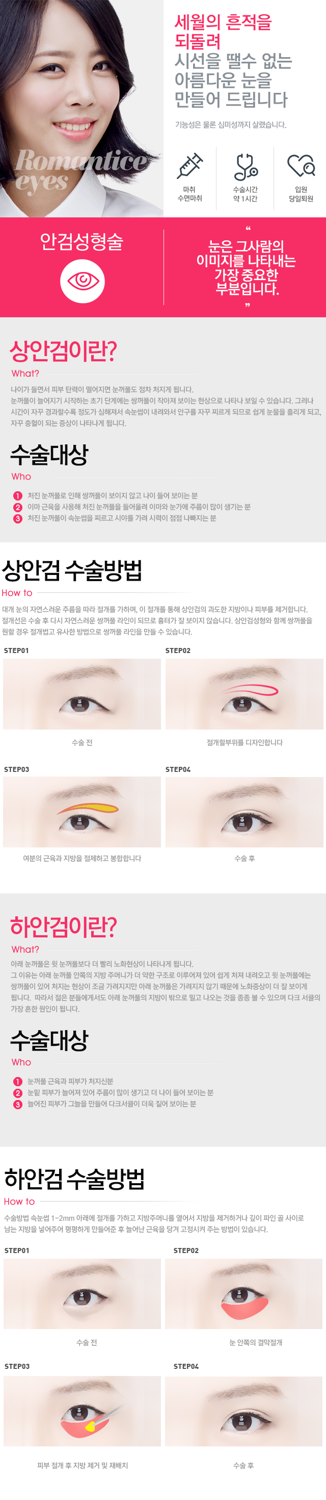 안검성형술