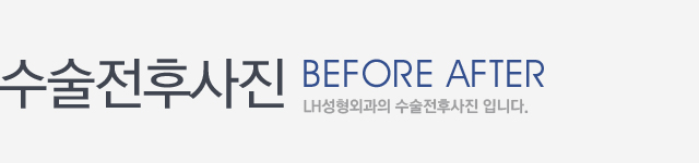 수술전후사진